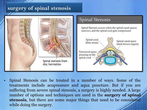 PPT - Surgery for Spinal Stenosis PowerPoint Presentation, free ...