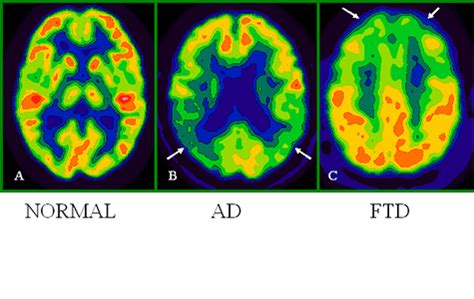 What is a PET Scan? - Healthy Brains by Cleveland Clinic