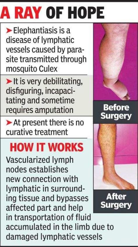 Central India’s 1st surgery on elephantiasis done in Nagpur | Nagpur ...