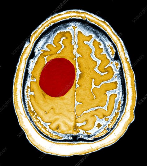 Enhanced Large Meningioma on MRI - Stock Image - C027/1689 - Science ...