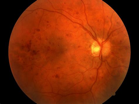 Diabetic Retinopathy Exams in Primary Care - Physician's Weekly