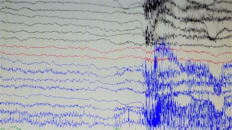 Abnormal eeg results - naxrewall