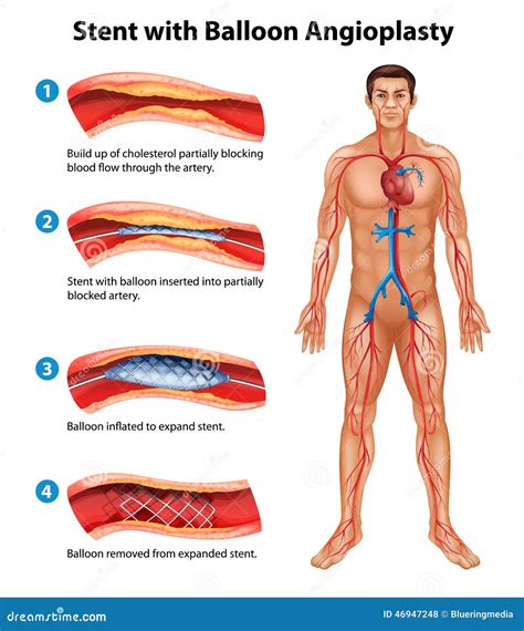 Stent Angioplasty Procedure Stock Vector - Illustration of embolism ...