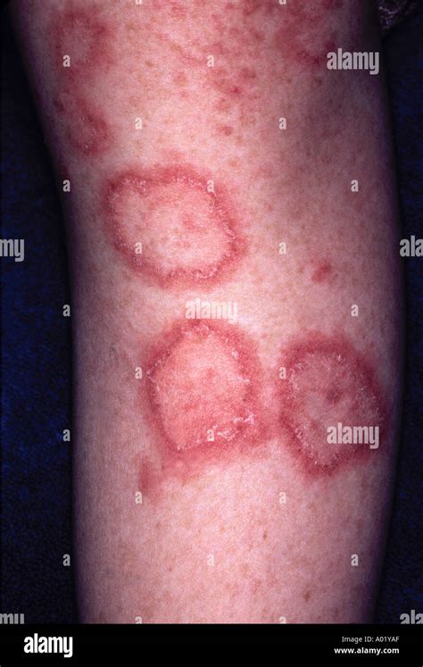 skin lesions discoid lupus 33 year old female Stock Photo: 3217326 - Alamy