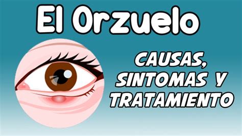 EL ORZUELO, Causas, síntomas, diagnóstico y tratamiento - YouTube