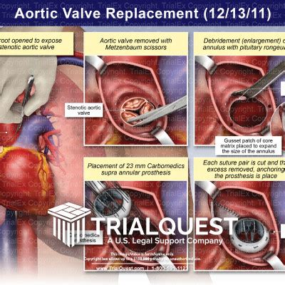 Aortic Valve Replacement - TrialExhibits Inc.