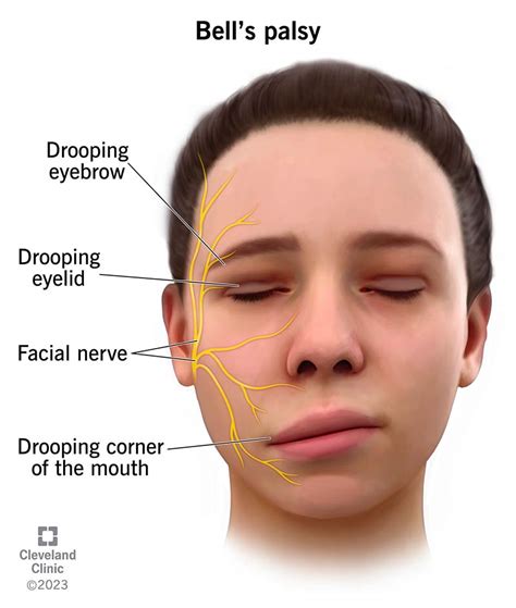 Bell’s Palsy: What It Is, Causes, Symptoms & Treatment