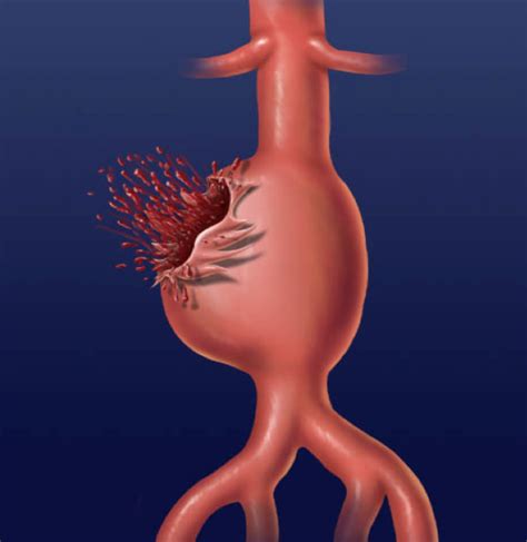 รายการ 98+ ภาพ abdominal aortic aneurysm อาการ ใหม่ที่สุด - VTTN