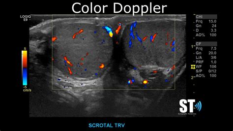 Testicular/Scrotal Doppler Protocol – Sonographic Tendencies