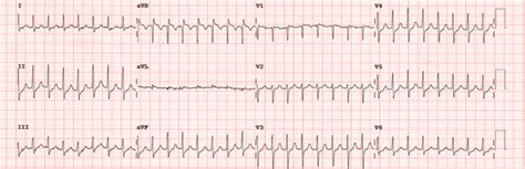 Arrhythmias