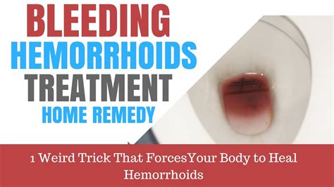 Bleeding Hemorrhoids Treatment Home Remedy - 48 Hour Cure - YouTube