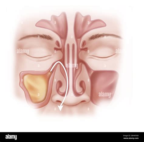 Sinusitis of the right maxillary sinus. The sinus is filled with mucus ...