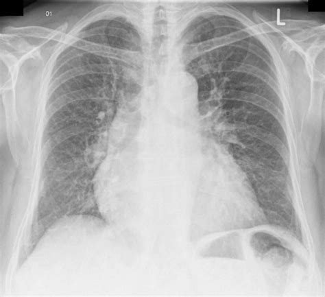 Pulmonary Congestion On Chest X Ray