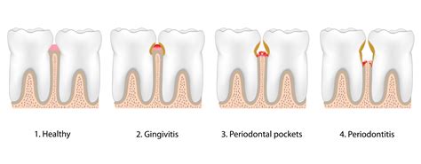 Gum Disease Gingivitis Treatment - Warsaw, IN Periodontal Health Procedures