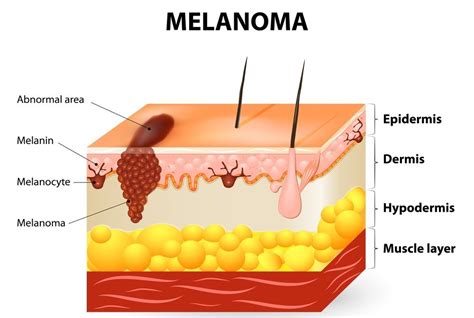 Metastatic Melanoma | Causes, Symptoms, Prognosis and Treatment - Page ...