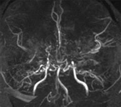 Moyamoya disease | UF Health, University of Florida Health