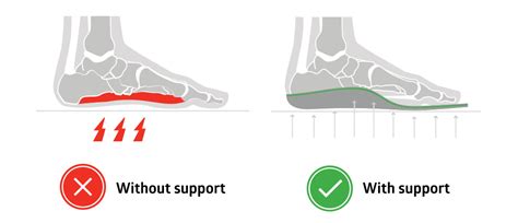 Flat Feet and Curing Related Pain with Orthopedic Insoles - SOLE