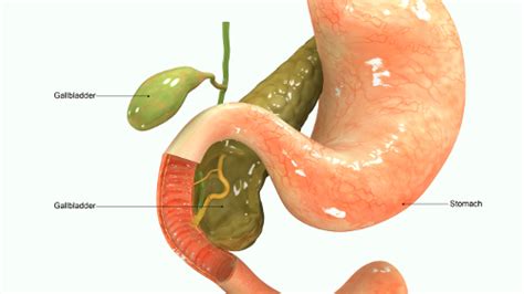 Gallbladder Sludge: Causes, Symptoms, and Treatment of Biliary Sludge