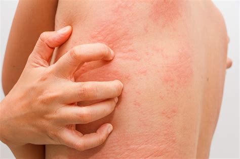 Skin Allergies & Rashes: Do You Know What to Do? - Aesthetic ...