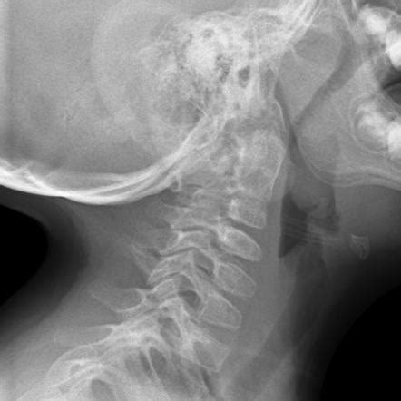 Atlanto Occipital Joint Xray