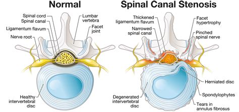 What Is the Newest Treatment for Spinal Stenosis? | Premia Spine