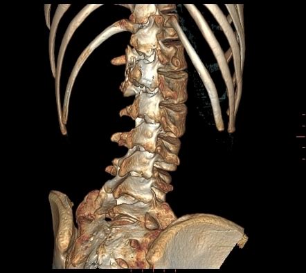 Osteoblastoma - vertebral | Image | Radiopaedia.org