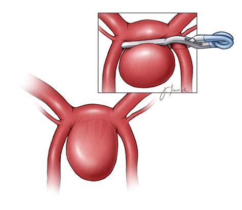 Anterior Communicating Artery Aneurysm | The Neurosurgical Atlas