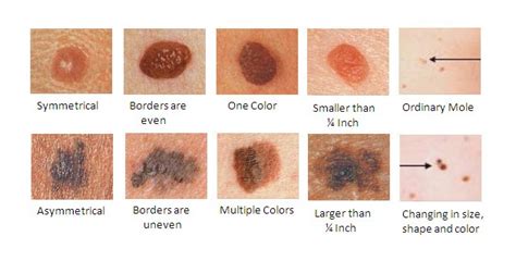 Small Red Moles On Skin: Everything You Need To Know