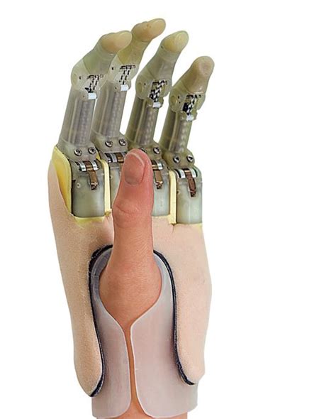 Partial Hand Prosthesis at best price in Jaipur by Jaipur Foot ...