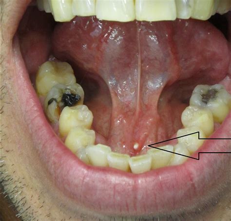 Sialolithiasis - Clinical Features - Management - TeachMeSurgery