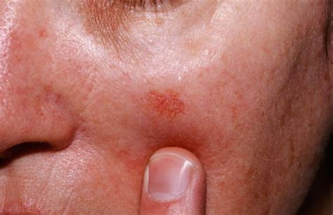 Actinic Keratosis - Causes, Symptoms & Actinic Keratosis Treatment