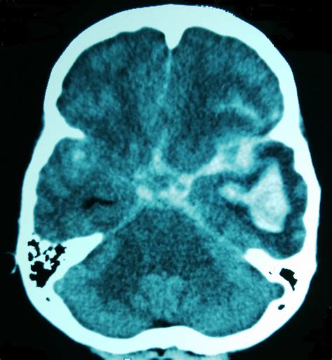 Causes of subarachnoid haemorrhage | General center | SteadyHealth.com