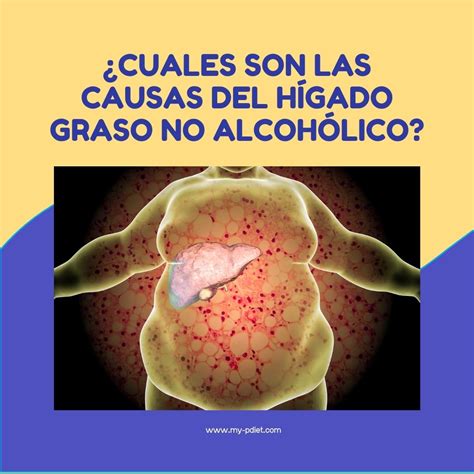 ¿Cuales son las causas del hígado graso no alcohólico?