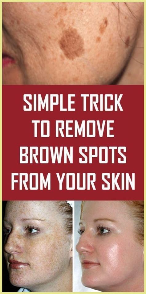 Simple Trick To Remove Brown Spots From Your Skin | Spots on face ...