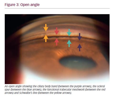 Gonioscopy—A Primer - touchOPHTHALMOLOGY