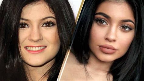 Kylie Jenner Before And After Plastic Surgery Photos