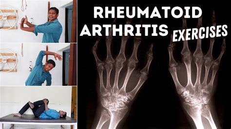 7 Best Rheumatoid Arthritis Exercises for Hand & Leg | Patient Talk