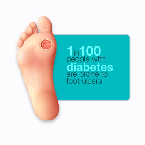 Diabetic Foot Ulcers Risk Factors Symptoms Treatment