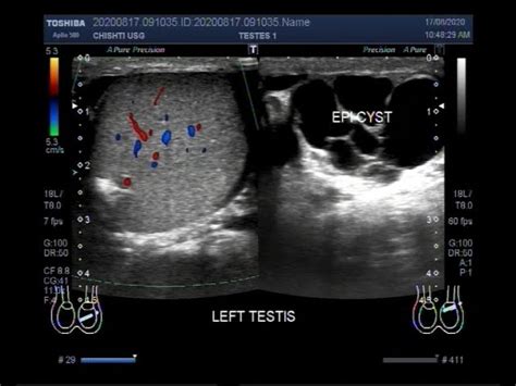 Epididymal Cyst