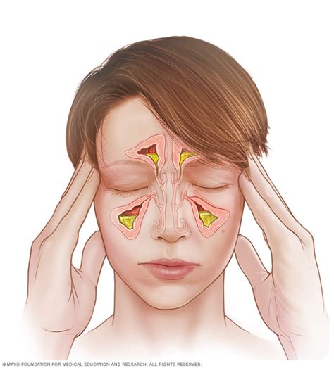 Acute sinusitis - Symptoms and causes - Mayo Clinic