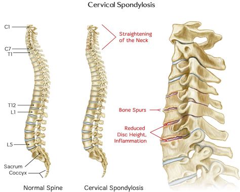 Cervical Spondylosis - Causes, Symptoms, Exercises, Treatment