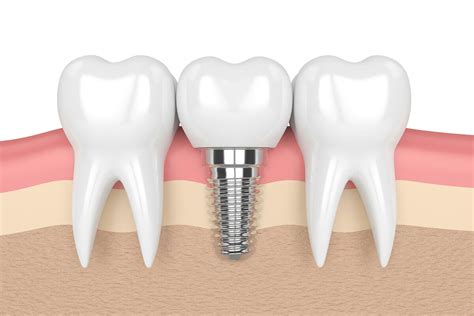 Dental Implant Crowns in Cincinnati | Eastgate Dental