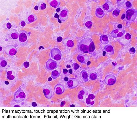 Pathology Outlines - Plasmacytoma