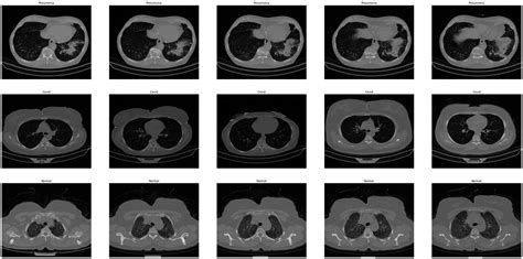 COVID-19: Lung CT scan detection. This is a quick article about my ...