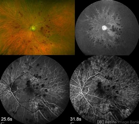 Ocular Ischemic Syndrome - Retina Image Bank