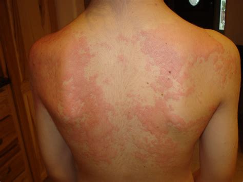 Pics Photos - Hives From An Allergic Reaction