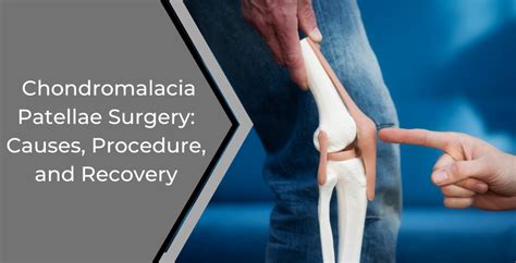 Chondromalacia Patella Surgery: Causes, Procedure, and Recovery - Dr ...