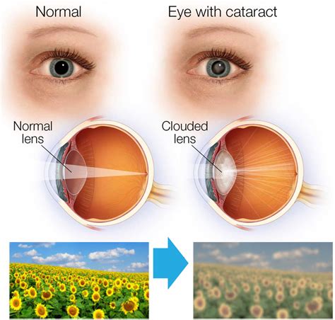 Glaucoma and Cataracts - Glaucoma Associates of Texas