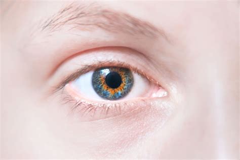 Central Heterochromia: Types and Causes | MyVision.org