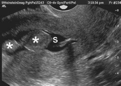 Weinstein Imaging Associates - Sonohysterography